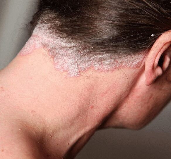 Cómo tratar la psoriasis