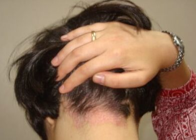 Psoriasis en la cabeza