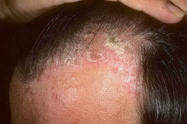 Síntomas de psoriasis