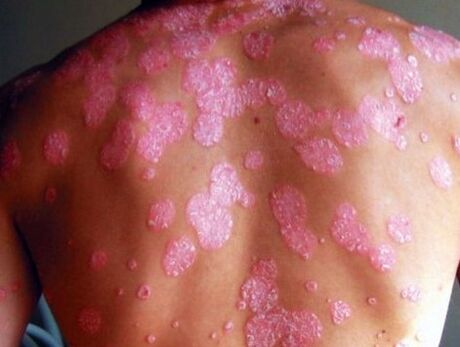 Enfermedad psoriásica