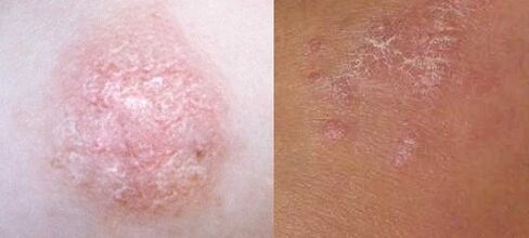 Psoriasis en la etapa inicial